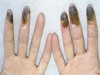 Chẩn đoán hình ảnh tổn thương và các đầu ngón tay hoại tử trong bệnh Buerger.