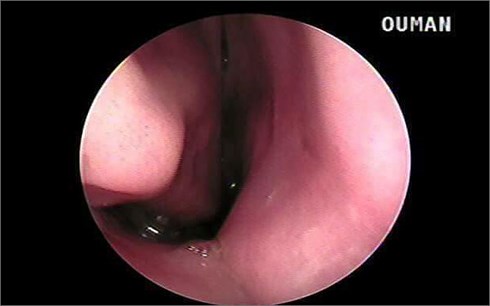 Hình ảnh nội soi cho thấy con vắt “khủng” đang “cư trú trái phép” trong mũi của bệnh nhân.