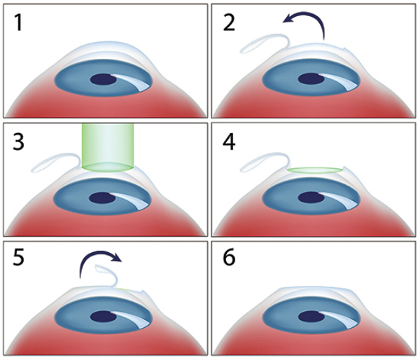 Các bước trong phương pháp phẫu thuật Lasik. 