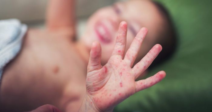 Bị tay chân miệng trẻ thường xuất hiện mụn nước ở các vị trí đặc biệt như họng, quanh miệng, lòng bàn tay, lòng bàn chân, mông, đầu gối…