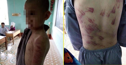 Những thương tích trên cơ thể em D.