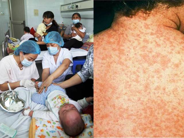 Bệnh sởi có thể gây ra nhiều biến chứng nguy hiểm. Ảnh minh họa.