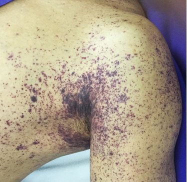 Bệnh nhân nhiễm liên cầu khuẩn lợn bị ban xuất huyết hoại tử rải rác khắp cơ thể (Ảnh có tính chất minh họa).