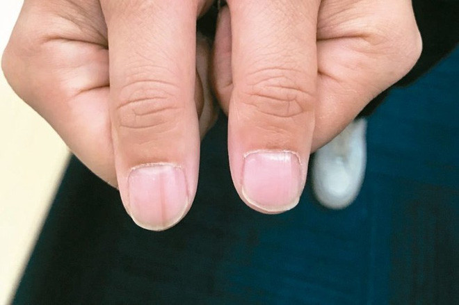 Không phải xem chỉ tay, nhìn móng tay của mình thuộc loại nào trong 7 kiểu dưới đây sẽ giúp bạn đoán được sức khỏe của bản thân - Ảnh 2. Không phải xem chỉ tay, nhìn móng tay của mình thuộc loại nào trong 7 kiểu dưới đây sẽ giúp bạn đoán được sức khỏe của bản thân - Ảnh 2.