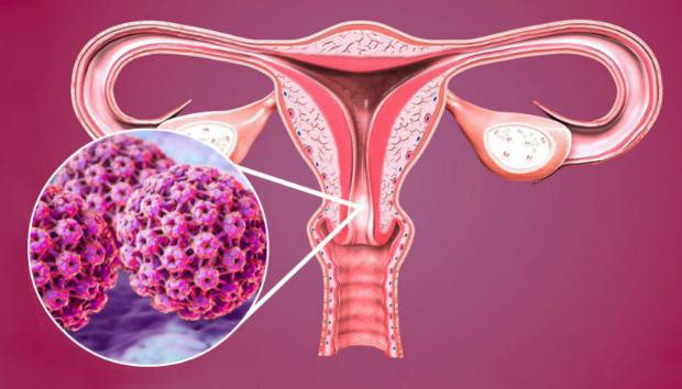 photo-1629347701108 Nhiễm HPV là nguyên nhân gây ra khoảng 70% các ca ung thư cổ tử cung.