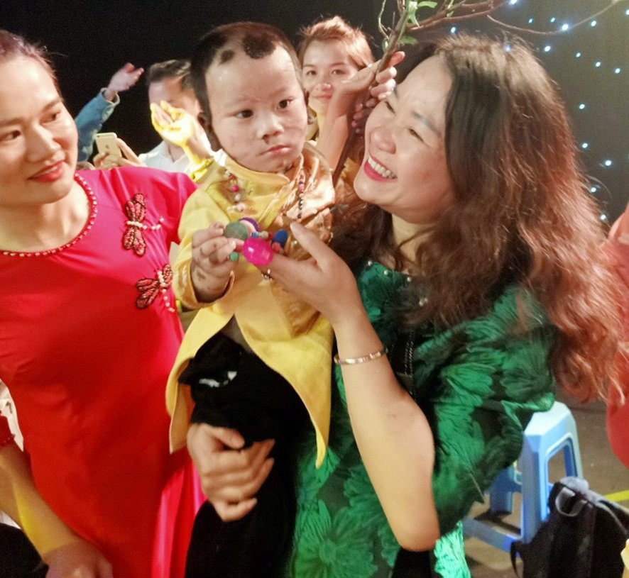 Chị Bùi Thúy Hải (bên phải) cùng cháu Trần Thế Đà (21 tháng tuổi, huyện Hải Hà) sau khi được phẫu thuật bớt bẩm sinh. (Ảnh nhân vật cung cấp)