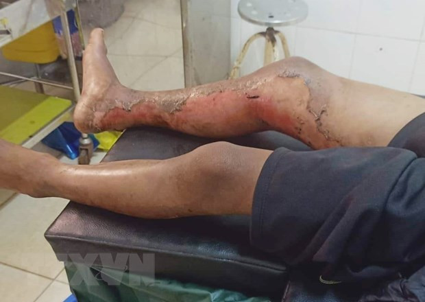 Thông tin thêm về vụ cháu bé 8 tuổi bị bỏng xăng ở Đắk Lắk hình ảnh 1 Thong tin them ve vu chau be 8 tuoi bi bong xang o Dak Lak hinh anh 1